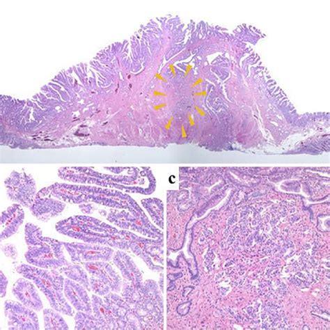 Figure10 Histological View Of The Resected Specimen A Low Power