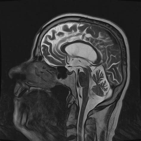 Endoscopic Third Ventriculostomy Encyclopedia Of Neuroendoscopic
