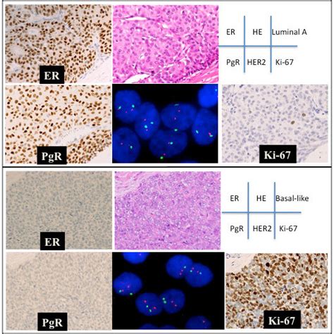 Pdf Luminal A And Luminal B Her Negative Subtypes Of Breast Cancer