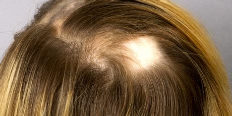 Alopecia Areata Diagnosis, Tests, Treatments | Dr. Batul Patel