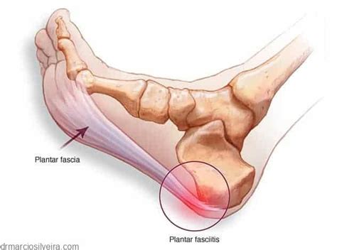 Fascite Plantar O Que Sintomas E Tratamentos Dr M Rcio Silveira