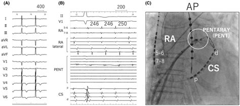 A Twelvelead Ecg B Intracardiac Recording During Atrial