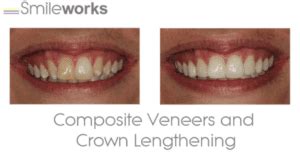 Veneers Cost In Unbiased Price Comparison By Dentists