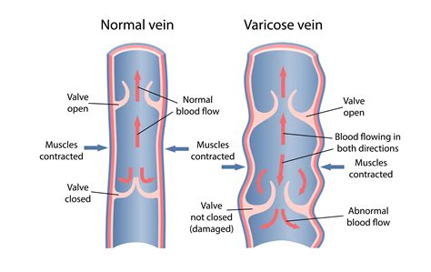 Chronic Venous Insufficiency - El Paso, TX: Imaging & Interventional ...