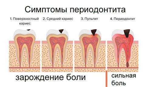 Periodontitis The Reasons Symptoms And Treatment