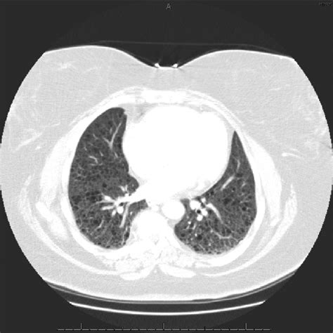 Lymphangioleiomyomatosis Lam Computed Tomography Ct Scan