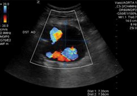 Intravascular Sonography Assessment Of A Type III Endoleak Of An Aortic