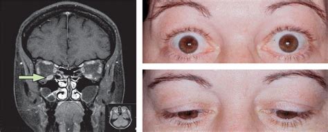 Miller Fisher Syndrome: Symptoms, Diagnosis, and Treatment