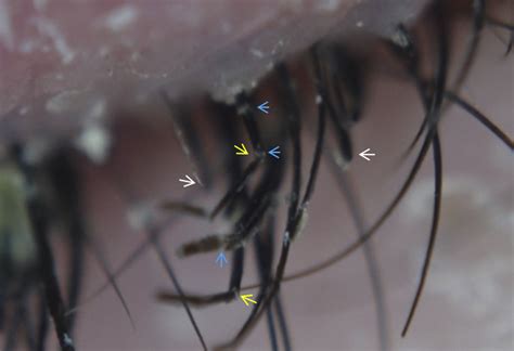 Trichoscopy Of The Eyelashes In Tinea Blepharo Ciliaris Shows The Full Spectrum Of Tinea Capitis