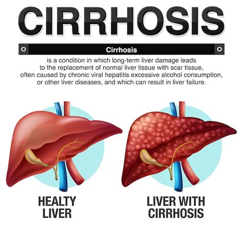 Infographie Sur La Cirrhose Du Foie Vecteur Gratuite