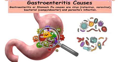 Gastroenteritis Causes Stomach Flu Virus Bacterial Gastroenteritis