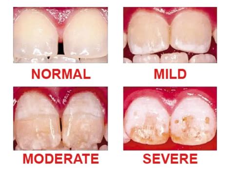 Dental Fluorosis - Southpointdentistry