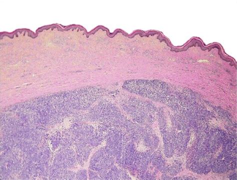 Merkel Cell Carcinoma Histology / Merkel Cell Carcinoma Treatment Pdq ...