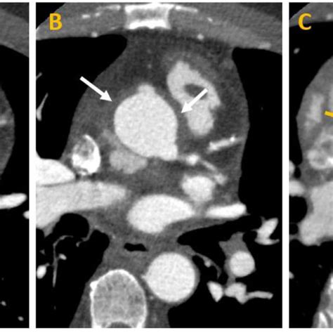 Cta Heart Morphology Axial A C Shows Bileaflet Prosthetic Aortic