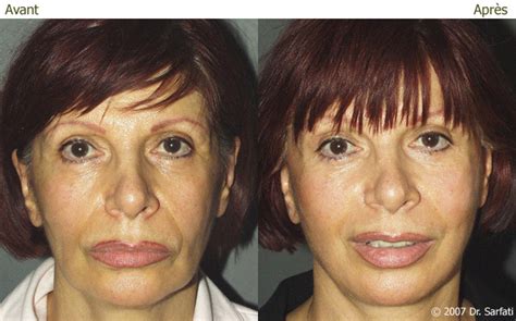 Lifting Cervico Facial Photos Avant Apr S Chirurgie Esth Tique Az