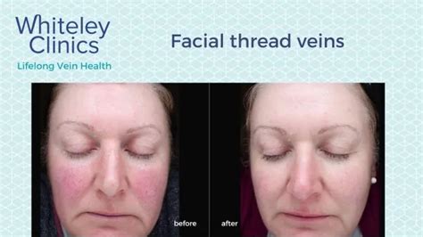 Remove Facial Veins South Florida Telegraph