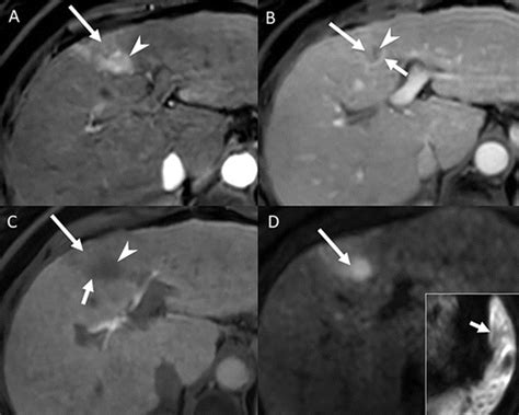 Imaging To Predict Prognosis In Hepatocellular Carcinoma Current And