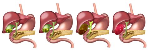 O Que Colecistectomia Previa Braincp