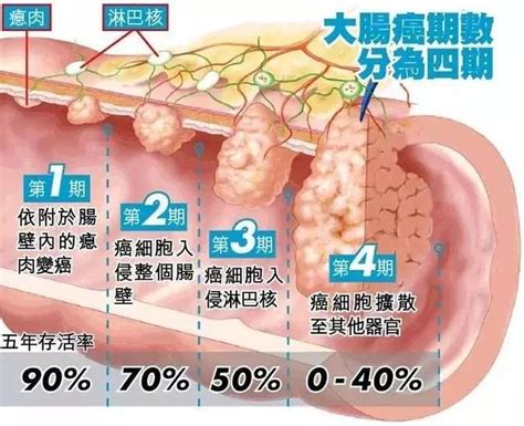 2017美國癌症報告：普查腸鏡帶來驚人效果 每日頭條