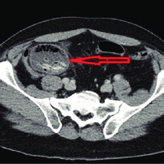 Axial View Of The Ct Scan Of The Abdomen And Pelvis Showing The Mass In