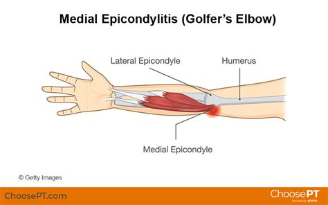 Guide | Physical Therapy Guide to Golfer's Elbow (Medial Epicondylitis ...