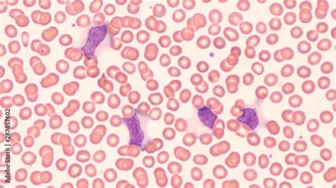 Foto De Photomicrograph Of Peripheral Blood Smear Showing Atypical