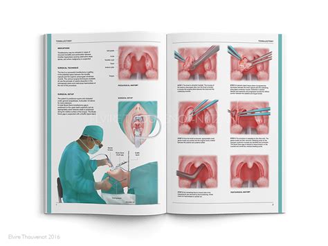 Tonsillectomy — Elvire Thouvenot Nitzan