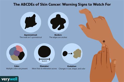 What Is Nonmelanoma Skin Cancer