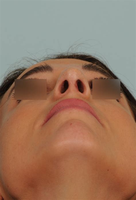 Photos de rhinoplastie avec nez dévié ou tordu avant et après