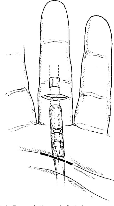 Figure 1 From Retrieval Of The Retracted Flexor Tendon Semantic Scholar