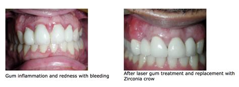 Laser Gum Recontouring Dr Ashish Kakar