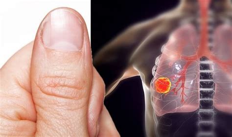 Lung cancer symptoms: Signs include finger clubbing | Express.co.uk