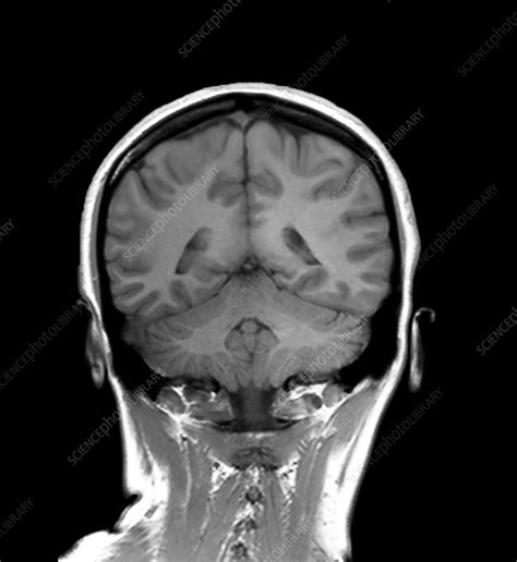 Healthy Brain Mri Scan