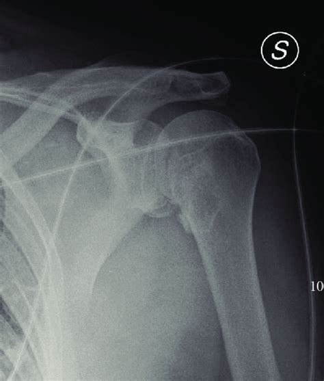 X-ray shows fracture of the humeral head and intrarotation of the arm. | Download Scientific Diagram