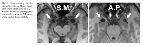 Social Neuroscience: Does bilateral damage to the human amygdala ...