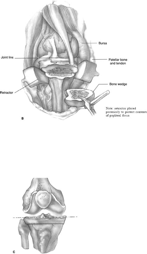 High Tibial Osteotomy | Musculoskeletal Key