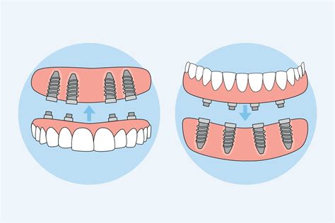 All-on-X Dental Implants | Pearland, TX Implant Dentists