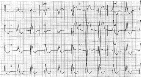 9 A 12 Lead ECG Showing RVOT Pacing With Positive QRS Complexes In II