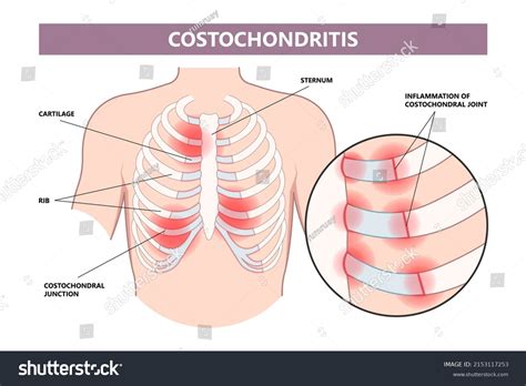 Tietze Syndrome Causes Signs Symptoms Diagnosis And 43 Off