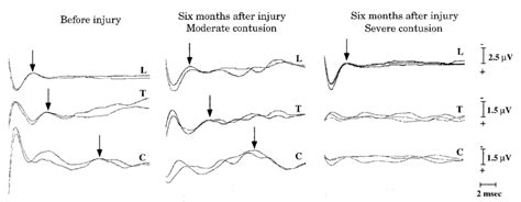 Somatosensory Evoked Potentials Sseps Obtained From Representative