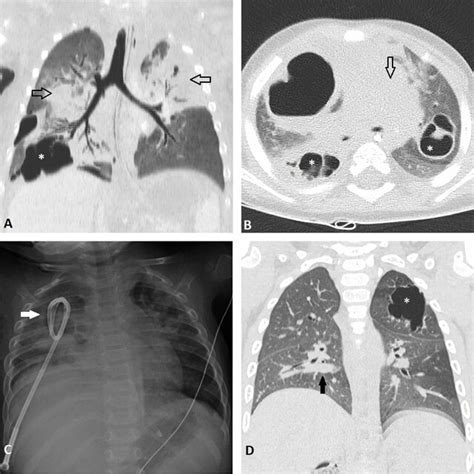 Images From Case Iii A B Coronal Minip And Axial Ct Scans Show