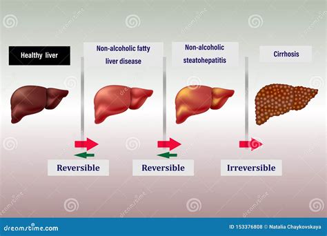 La Enfermedad Del Hígado Flechas De La Etapa Indica Etapas Reversibles