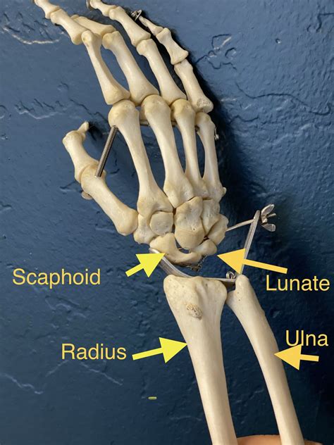 FOOSH injury and why it can cause wrist pain. — SCR3