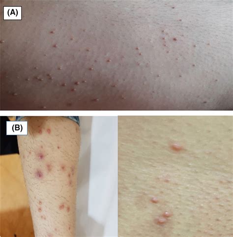 Atypical Molluscum Contagiosum On Multiple Sclerosis Patients Treated With Fingolimod A Case