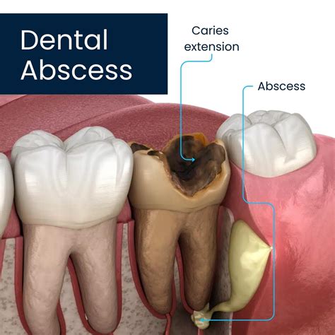 7 Important Care Tips for a Dental Abscess | Broadway Family and Cosmetic Dentistry