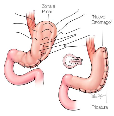 Plicatura Gástrica Cirugía De Obesidad Monterrey