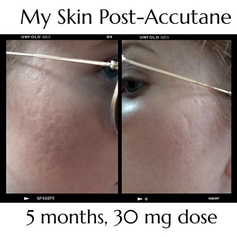 My Accutane Experience How Accutane Changed My Life