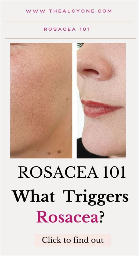 What triggers rosacea – Artofit