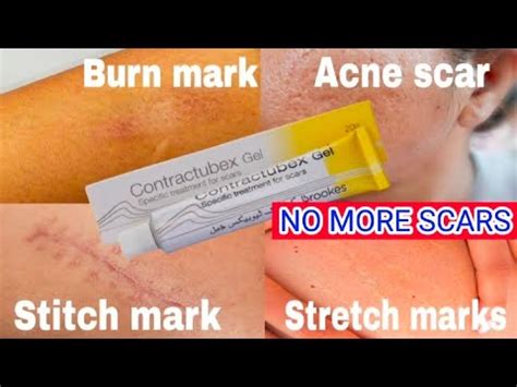 Contractubex Gel How To Remove Scar Best For Acne Scar Burn Mark