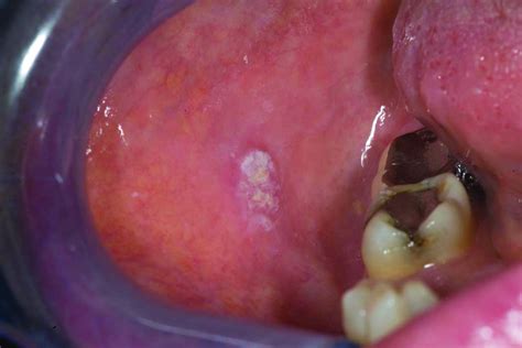 Squamous Cell Carcinoma Of The Oral Cavity In Nonsmoking Women A New